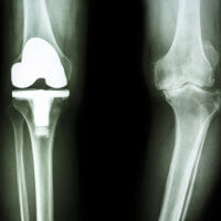 knee arthroplasty card