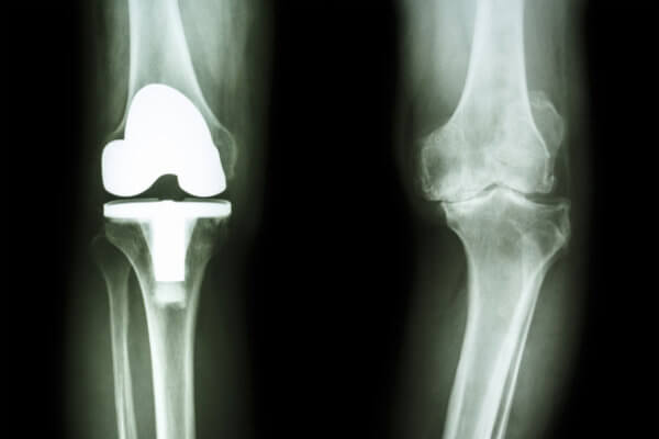 ακτινογραφία γονατου με εμφύτευμα