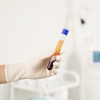 PRP θεραπεία με βλαστοκύτταρα — πλάσμα πλούσιο σε αιμοπετάλια